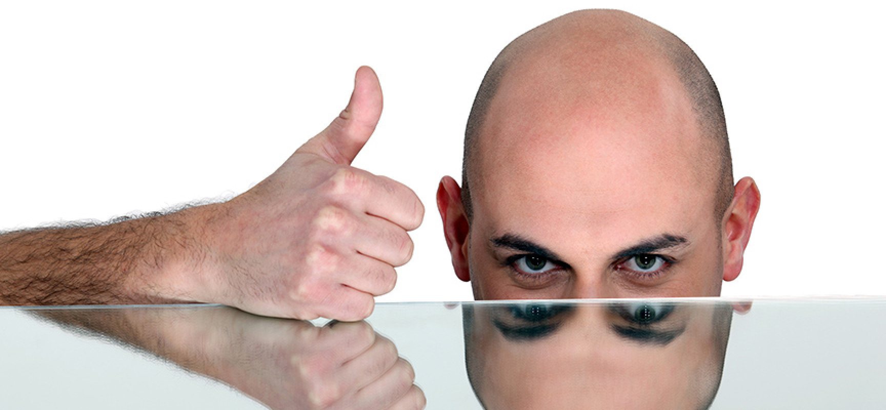 Tipos de alopecia o calvicie Tipos de alopecia o calvicie